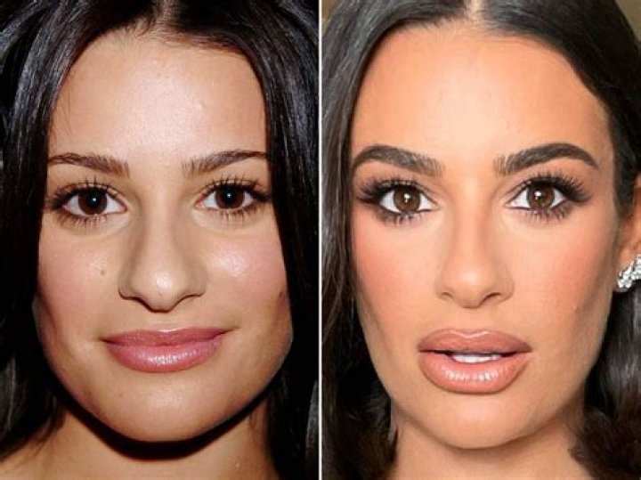 Lea Michele Plastic Surgery Before and After