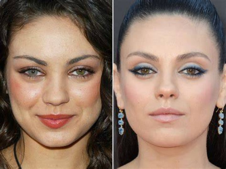 Mila Kunis Plastic Surgery Before and After