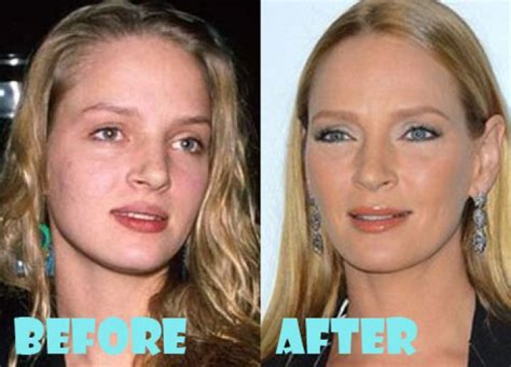 Uma Thurman Plastic Surgery Before and After